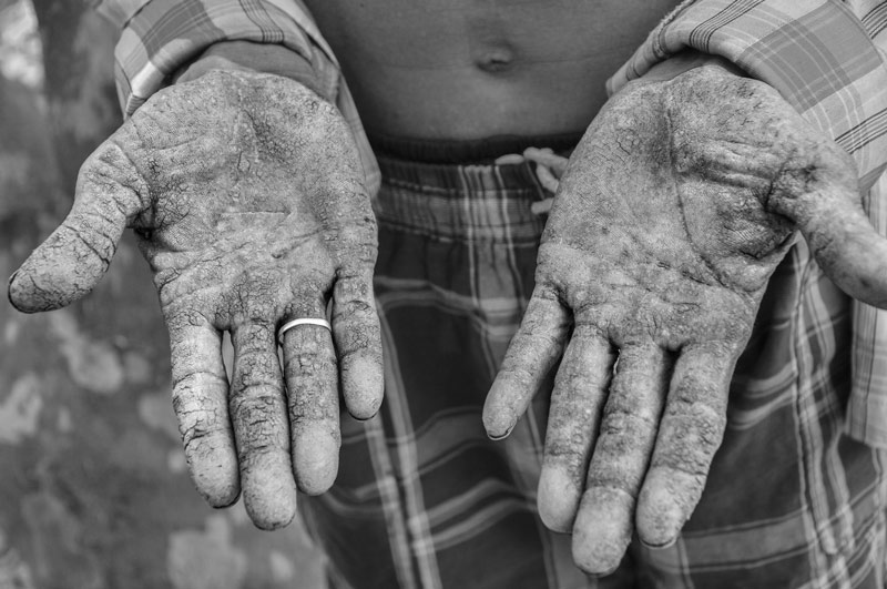 Severe keratosis in the palms of an arsenicosis patient in North 24 Parganas district, West Bengal